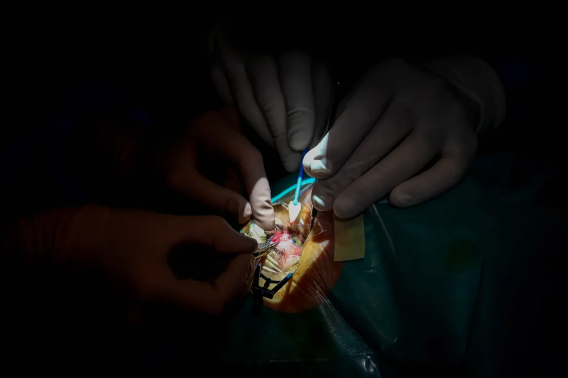 Operacja wszczepiania implantu do oka w celu leczenia jaskry przeprowadzona w szpitalu im. Żeromskiego 